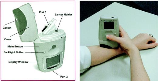 Figure 1 —. A: The automated device for alternative site testing. B: Glucose testing on the arm with the device.
