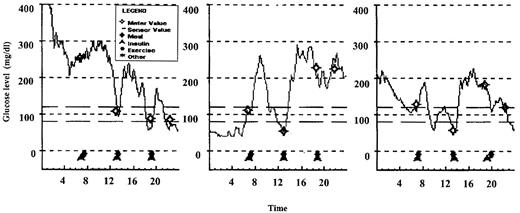 Figure 1—. The glucose sensor profile from an 11-year-old diabetic patient with frequent hypoglycemic episodes and high day-to-day variability of glucose profiles.