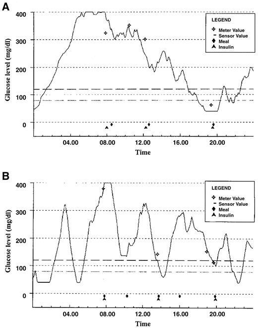 Figure 2—. An example of a prolonged hyperglycemic period in a 15-year-old girl with HbA1c = 9.1% (A) and rapid glycemic excursions in a 12.5-year-old boy with HbA1c = 7.5% (B).