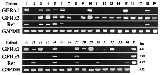 Figure 1—. RT-PCR analysis of GDNF receptors in ERMs derived from patients summarized in Table 1. cDNA derived from ERMs with PDR (patients 1–19) and idiopathic ERMs (patients 20–34) was analyzed by PCR using primers specific for 441-bp GFRα1, 339-bp GFRα2, and 439-bp Ret, respectively. As controls for cDNA integrity, the cDNA was also amplified with primers for 452-bp G3PDH. After 35 cycles, 15 μl of each sample was electrophoresed on a 2% Tris borate–EDTA agarose gel and stained with ethidium bromide. Note the high expression levels of GFRα2 as well as the low expression levels of GFRα1 in ERMs derived from PDR patients. P, positive controls using human cDNA acquired from skeletal muscle.