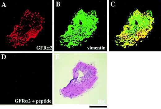 Figure 2—. Expression of GFRα2 (A) and vimentin (B) in the ERM derived from a PDR patient aged 52 years with a 13-year history of diabetes. C: Double-labeling method demonstrates the expression of GFRα2 protein in glial regions. D: Negative control stained with GFRα2 antibody preabsorbed with blocking peptide. E: Hematoxylin and eosin staining of the adjacent section. Bar represents 200 μm.