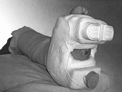Figure 1—. Ulcer of the midfoot treated with a cast boot.