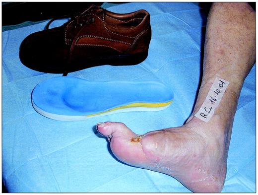 Figure 2—. Molded insole and rocker bottom sole footwear with thermoformable leather.
