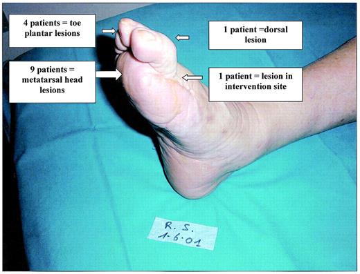 Figure 4—. Site of reulceration.