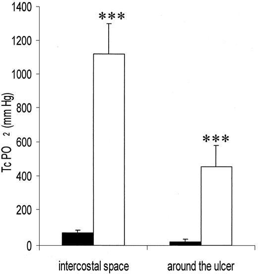 Figure 1—. TcPo2 MEASUREMENTS IN THE SECOND INTERCOSTAL SPACE AND AROUND THE ULCER IN PATIENTS UNDERGOING HBO IN ROOM AIR (▪) AND AFTER THE FIRST HYPERBARIC SESSION (□). ***P < 0.001.