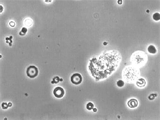Figure 1—. Glomerular hematuria characterized by the presence of ≥5% acanthocytes (ring-formed erythrocytes with vesicle-shaped protrusions) among all erythrocytes excreted (phase-contrast microscopy).