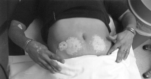 Figure 1—. Vitiligo vulgaris on the abdominal skin of a young woman associated with the subcutaneous infusion of insulin lispro.