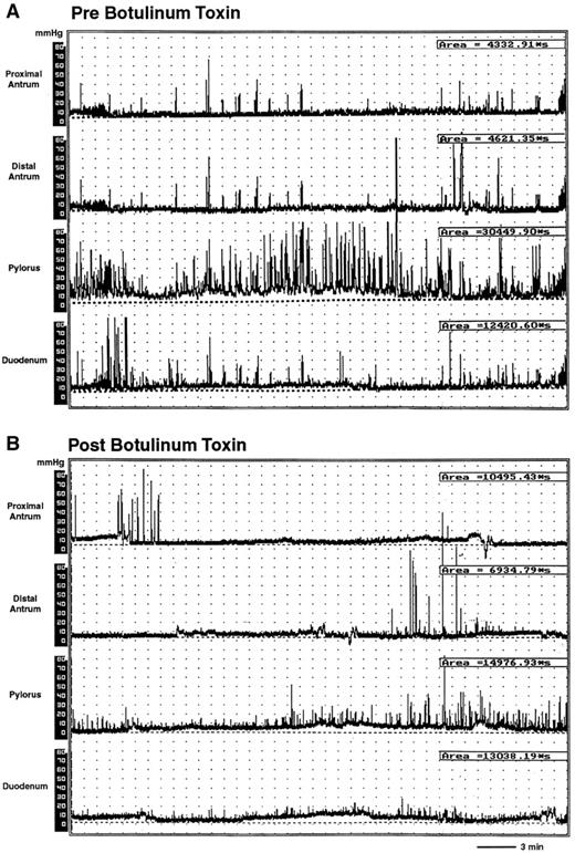 Figure 2—. Antropyloric manometry using a Dentsleeve catheter. A and B: The first two panels reflect activity in the antrum (proximal and distal), the third panels reflect pyloric activity, and the last panels reflect duodenal activity. A: Baseline (preinjection). Area under the curve for the pylorus in this patient is 30,449.90 s. B: Postbotulinum toxin injection of the pylorus. In the same patient, a reduction in phasic activity in the pylorus can be visualized. Tonic-phasic activity, as measured by the area under the curve, decreased to 14,976.90 s.