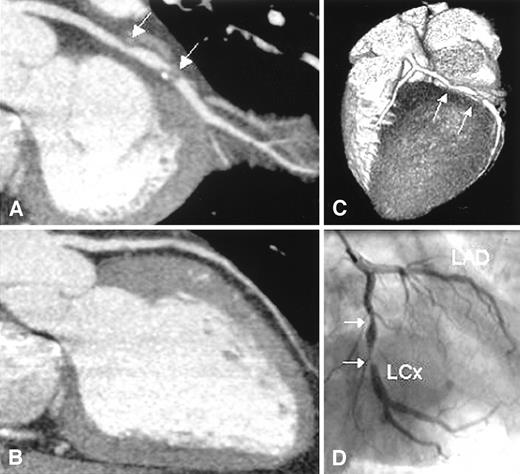 Figure 1—. Curved multiplanar reconstruction of a left circumflex coronary artery (LCx) with severe narrowing of the lumen (A). No abnormalities, however, were observed in the left anterior descending coronary artery (LAD) of this patient (B). Also, in the three-dimensional volume-rendered reconstruction (C), stenoses in the LCx as well as patency of the LAD are clearly visible. Findings were confirmed by conventional X-ray angiography (D).