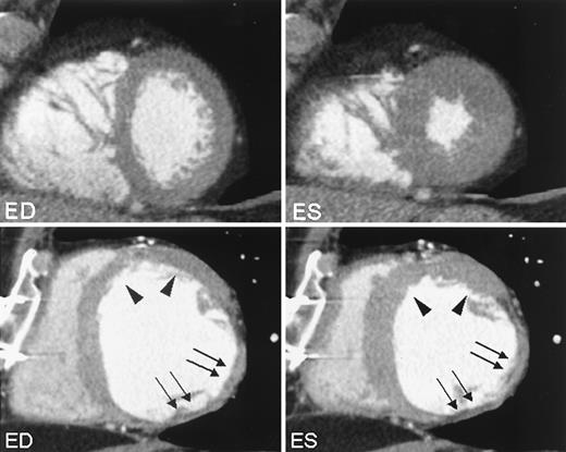 Figure 3—. MSCT short-axis reconstructions in end diastole (left) and end systole (right). Upper panels: Normal systolic wall thickening is clearly present in all segments. Lower panels: Short-axis reconstructions of a patient with a previous inferolateral infarction are shown. Although preserved wall motion is still present in the anterior region (arrowheads), akinesia of the severely thinned wall is clearly visible in the infarcted region (arrows).
