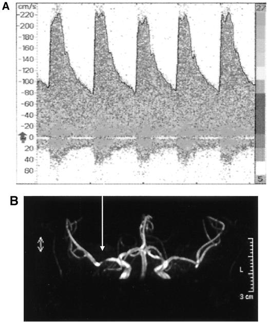 Figure 1—. An example of MCA stenosis detected by transcranial Doppler ultrasound (A) with a peak systolic velocity up to 220 cm/s and turbulent flow. The stenosis was confirmed by a magnetic resonance angiography (B).