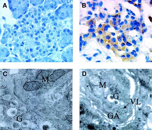 Figure 1—. A and B show the results obtained by an immunoperoxidase technique for anti–HCV-E2 in pancreatic islets (original magnification ×400). In A, the endocrine cells from a control pancreas are completely devoid of the viral antigen. In B, the endocrine cells from an HCV-positive pancreas show a brown, finely granular staining, indicating the presence of the HCV proteins. C and D show the results obtained by electron microscopy (original magnification ×46,000). In C, a control β-cell is shown, with the characteristic insulin granules (G) and normal mitochondria (M). In D, a β-cell from an HCV-positive pancreas is represented, showing virus-like particles (VL) close to dilated, hyperplastic Golgi apparatus (GA) and round-shaped mitochondria with dispersed matrix and fragmented cristae.