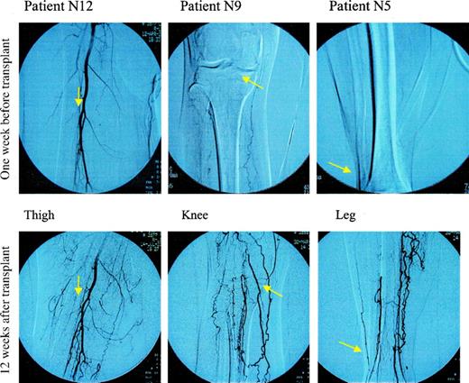 Figure 2—. Change in digital subtraction angiography of lower limbs in three patients (N5, N9, and N12) from the transplant group before and after cell transplantation, showing a significantly increased formation of new collateral vessels. Arrows direct to the same place of vessel or bone before and after transplantation.