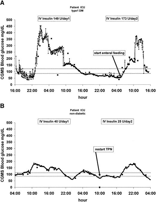 Figure 1—. Examples of CGM profiles. A: A brittle type 1 diabetic (DM) patient in cardiogenic shock; enteral feeding was started after 36 h. ▪, arterial blood glucose readings. B: A stable nondiabetic patient admitted due to respiratory insufficiency; parenteral nutrition was started after 30 h.