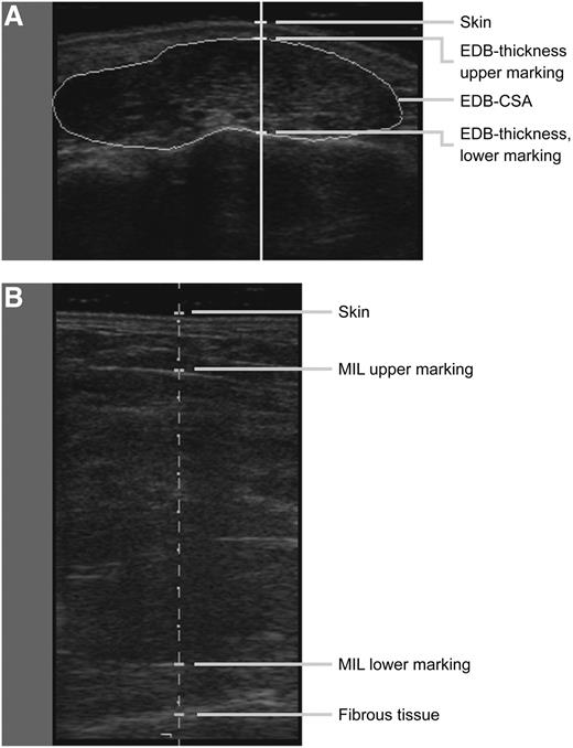 Figure 1—. A: Ultrasonographic image of CSA of the EDB muscle (U-EDB-CSA) and thickness of the EDB muscle (U-EDBt). B: Ultrasonographic image of thickness of the first dorsal interosseus muscle, the adductor hallucis muscle, and the first lumbrical muscle (U-MILt).