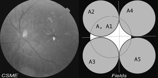 Figure 1—. Stereo-photograph pair and four peripheral fields of ADRES 3.0 five 45° field protocol with a sample image.