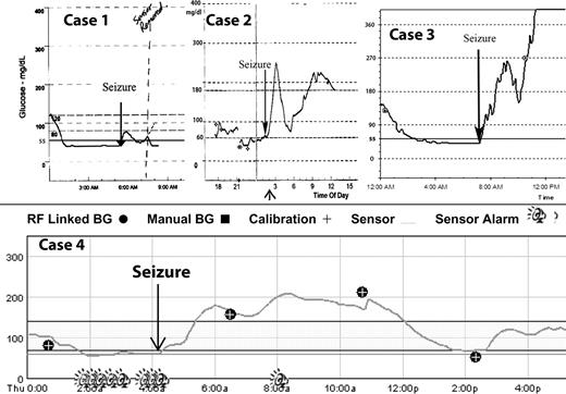Figure 1—. Case 1: 15-year-old male wearing an original Minimed CGMS. Case 2: 12-year-old female wearing a Minimed CGMS-Gold monitor. Case 3: 16-year-old female wearing the original Minimed CGMS. Case 4: 17-year-old female wearing a MiniMed 722 Paradigm real-time continuous glucose monitor. Alarm “bell” along time axis at bottom of graph indicates alarming (vibratory and then audio). BG, blood glucose.