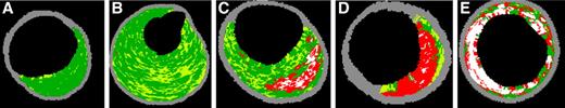 Figure 1—. Representative IVUS-VH image illustrating (A) IVUS-derived adaptive intimal thickening, (B) pathological intimal thickening, (C) fibroatheroma, (D) thin cap fibroatheroma, and (E) fibrocalcific.