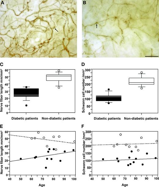 Figure 1—. Depiction of subepidermal nerve fibers and Schwann cells in dermal sheet preparations by immunostaining for NCAM/CD56. A: The subepidermal nerve plexus in a nondiabetic control patient is represented as a dense and regular network of nerve fibers ensheathed by Schwann cells. Branching of thick nerve fibers into thinner fibers can easily be discerned. Protrusions of Schwann cell nuclei (arrow) were present at regular intervals. The total nerve fiber length was 50.68 mm/mm2; 211 Schwann cells were detected per millimeter squared. B: In a representative diabetic patient, the subepidermal nerve plexus consisted of a sparse nerve fiber network dominated by thicker fibers with few ramifications. Schwann cell nuclei were sporadically present. The total nerve fiber length amounted to 22.26 mm/mm2 and 89 Schwann cell nuclei/mm2 were found. Scale bar: 100 μm. One protrusion containing a Schwann cell nucleus is shown as an example in A and B (arrow). C: Statistical analysis of the nerve fiber length of the subepidermal nerve plexus per millimeter squared of skin in diabetic patients compared with that of nondiabetic patients. The mean nerve fiber length for both groups is shown in box diagrams. In the diabetic group, the mean ± SD nerve fiber length was 26.38 ± 7.77 mm/mm2, which was significantly lower than that in the control group (48.52 ± 7.15 mm/mm2) (P = 0.0002; Mann-Whitney U test). D: Statistical analysis of the Schwann cell number contained in the subepidermal nerve plexus per millimeters squared of skin in diabetic patients compared with that in nondiabetic patients. In the diabetic group, the mean Schwann cell number was 107 ± 29 per millimeters squared compared with 216 ± 34 per millimeters squared in the control group (P = 0.0001; Mann-Whitney U test). E: Regression analysis of the nerve fiber length per millimeters squared with respect to the age of the individuals. No correlation could be found between these two parameters in the diabetic group (P = 0.2174) or the control group (P = 0.3716). F: Regression analysis of the Schwann cell number per millimeters squared with respect to age. No correlation could be found between these two parameters in the control group (P = 0.8774) or the diabetic group (P = 0.6672).