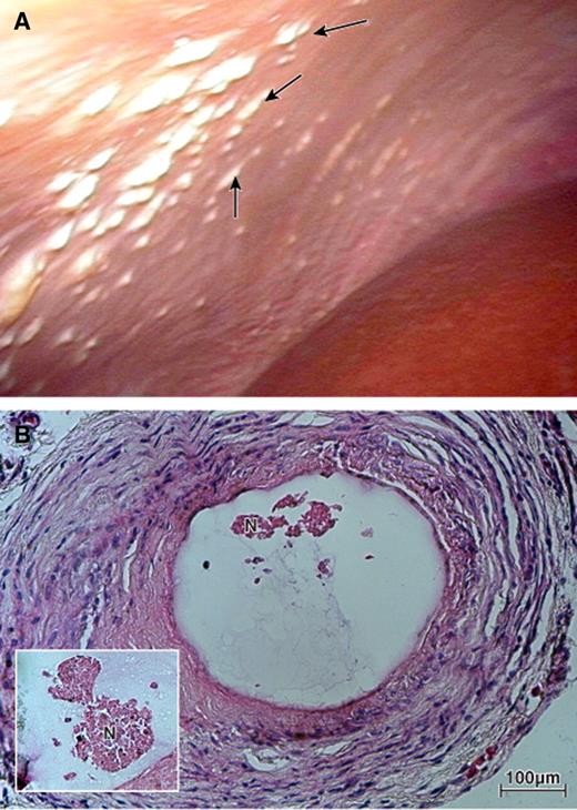Figure 1. Biopsy of the encapsulated human islets taken from the recipient of four islet infusions (total of 779,000 IEQs) 16 months after the first infusion. A: Clusters of capsules on parietal peritoneum (black arrows indicate some of the many clusters). B: Higher magnification showing necrotic islets (N) inside capsules (artifactually distorted because of fixing) surrounded by fibrous tissue containing few blood vessels. (A high-quality digital representation of this figure is available in the online issue.)
