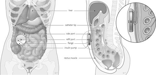 Figure 1. Schematic view of the position of the insulin pump and catheter in vivo.