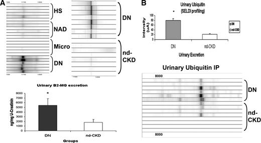Figure 3. Validation of β2MG and ubiquitin differential excretion. A, top: Representative SELDI spectra (gel view) showing β2MG excretion in patients with diabetic nephropathy compared with that in healthy subjects and patients with normoalbuminuria, microalbuminuria (left), and nd-CKD (right). Bottom: β2-MG urine (U) excretion as measured by ELISA (mean ± SEM) in patients with diabetic nephropathy compared with nd-CKD. B, top: Ubiquitin urine excretion as measured by SELDI analysis on the whole urine profile (mean ± SEM) in patients with diabetic nephropathy compared with nd-CKD. Bottom: SELDI profiling of urine ubiquitin immunoprecipitated by a specific monoclonal antibody (ubiquitin IP) and run on a CM10 ProteinChip array. Representative SELDI spectra (gel view) from six patients with diabetic nephropathy and eight patients with nd-CKD are shown. *P < 0.05. DN, biopsy-proven diabetic nephropathy; MICRO, microalbuminuric diabetic patients; HS, healthy subjects; NAD, normoalbuminuric diabetic patients.