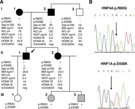 Figure 1. A: Pedigree and genotypes of the family, showing that the proband LN (II-1) carries both the variants, while his parents (I-1, I-2), his sister EN (II-2), and the sister's children (III-2, III-3) carry a single mutation in either HNF4A or HNF1A gene. Filled symbols identify subjects with diabetes, diagonal hatching represents subjects with neonatal macrosomia and hypoglycemia, empty symbols identify healthy individuals, the arrow indicates the proband. Additional clinical data are also reported; age is at diagnosis of diabetes (DM). B: Representative chromatograms of the HNF4A p.R80Q and HNF1A p.E508K mutations identified in the family. IRCP, immunoreactive C-peptide; IS, insulin sensitivity; na, not applicable; nd, not done; WC, waist circumference.