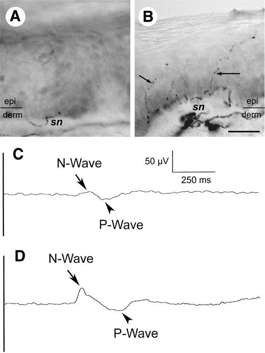 Figure 1. CHEP and skin innervation in type 2 diabetic neuropathy. Skin biopsies were stained with anti-protein gene product 9.5 (PGP 9.5) antiserum, and IENF densities were quantified. Skin innervation and CHEP in a representative patient with type 2 diabetic neuropathy (A and C) compared with an age- and sex-matched subject (B and D) are illustrated. A: Skin biopsy from a 60-year-old female patient shows marked depletion of cutaneous nerve terminals in the epidermis (epi) with an IENF density of 0.9 fibers/mm. Only loose and fragmented subepidermal nerve bundles (sn) are recognizable in the dermis (derm). B: Skin biopsy from a 58-year-old healthy woman shows varicose PGP 9.5(+) IENFs (arrows) in the epidermis with an IENF density of 7.9 fibers/mm. C and D: Averaged tracing of the CHEP (C) from the patient in A shows attenuation of N- and P-waves and relatively prolonged N-wave latency comparing with the well-defined complex of N- and P-waves (D) from the control subject in B. (For A and B, bar = 25 μm; for C and D, time base = 250 ms and sensitivity = 50 μV.)