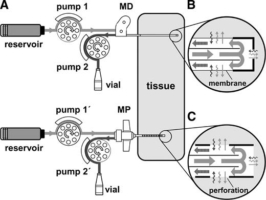Figure 1. Schematic of the experimental set-up for the assessment of insulin's effect on the glucose concentration at the tissue site of insulin delivery. A: A microperfusion (MP) and a microdialysis (MD) catheter were inserted into subcutaneous adipose tissue of healthy subjects (n = 5). Both catheters were perfused sequentially with an insulin-free solution (mannitol) for 2 h, a standard human insulin preparation (100 units/ml, Actrapid) for 6 h, and, again, an insulin-free solution (mannitol) for 2 h. Perfusion of each catheter was accomplished by applying two peristaltic pumps, with one pump (1, 1′) attached to the inflow tubing and another (2, 2′) to the outflow tubing (dual-pump operation mode [9]). B and C: The perfusate streamed through the inflow tubing and the inner cannula to the tip of the catheter and then entered the space between inner and outer cannula of the catheter (bold arrows). By operating the inflow pump at a higher speed than the outflow pump, a fraction of the perfusate entering the space between inner and outer cannula was forced to flow through the perforations and membrane pores of the MP and MD catheter, respectively, to the surrounding tissue (tissue-directed flows indicated by thin straight arrows). The magnitude of this flow fraction and, thus, the amount of perfusate solutes (e.g., insulin) convectively transported to the tissue was controlled by controlling the difference between the inflow and outflow rates of the catheter. In parallel to this convective tissue-directed solute transport, diffusive bidirectional solute transport took place across the perforations and membrane pores of the MP and MD catheter, respectively (wavy arrows), thereby causing ISF solutes (e.g., glucose) to enter the fluid fraction that flowed in the space between inner and outer cannula of the catheter (bold striped arrows). Along with the permeated ISF solutes, this fluid fraction was pumped continuously through catheter outlet and outflow tubing to the collecting vial. The efficiency by which glucose was transported via diffusion from the ISF of the tissue into the catheter (glucose recovery) was measured by applying the ionic reference technique (7,8).