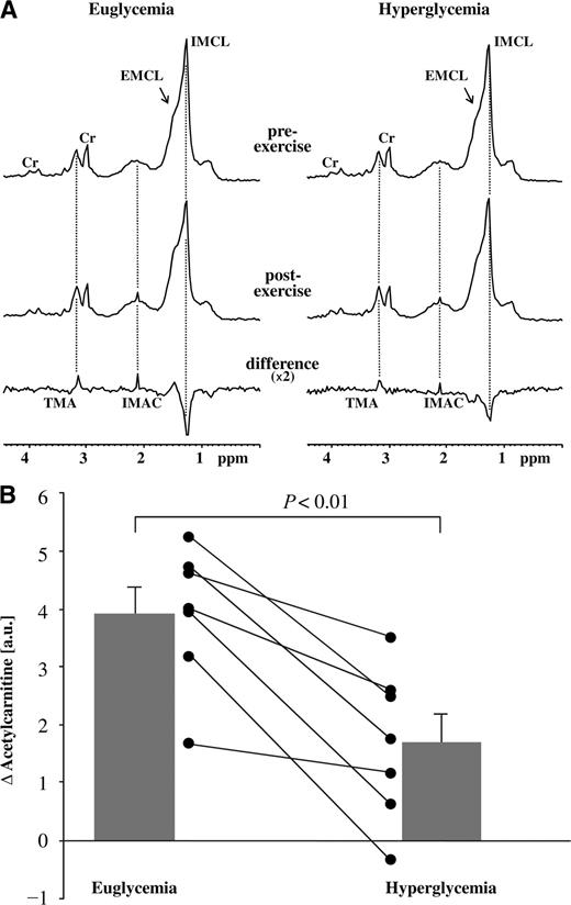 Figure 1. A: 1H magnetic resonance spectra were obtained from musculus vastus intermedius before and after 120 min of moderate-intensity exercise in euglycemia or hyperglycemia. Summed spectra are portrayed for pre- and postexercise. The difference spectra show positive peaks for the acetyl group of IMAC at 2.13 ppm and its trimethylammonium (TMA) group at 3.2 ppm, as well as negative contribution from intramyocellular lipids (IMCL) (reduced lipid levels after exercise). The trimethylammonium resonance is not used in the present work because, as reported earlier (5), its difference peak does not readily scale in intensity with the acetylcarnitine peak, probably related to differences in molecular properties. Cr, methyl and methylene peaks of creatine/phosphocreatine. Note that in the summed spectra, differentiation between extramyocellular lipids (EMCL) and intramyocellular lipids is difficult, whereas all analyses were done in individual spectra. B: Exercise-related differences in IMAC levels in euglycemia and hyperglycemia. Black lines reflect individual results; bars reflect mean ± SEM. Acetylcarnitine content is expressed in absolute arbitrary units relative to the water signal obtained from separate reference scans. P represents the comparison of differences in euglycemia vs. hyperglycemia.