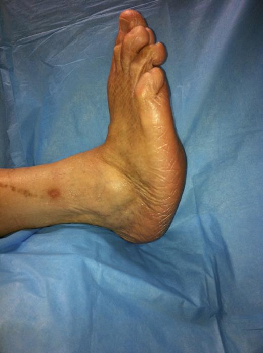 Figure 1. The typical appearance of a later-stage Charcot foot with a rocker-bottom deformity.