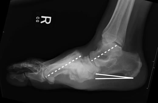 Figure 2. Lateral X-ray of a Charcot foot deformity showing a dislocation of the tarsometatarsal joint with break in the talo-first metatarsal line (dashed lines) and a reduced calcaneal inclination angle (solid lines).