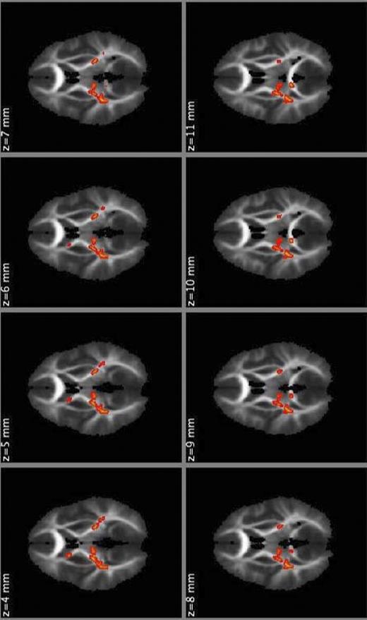 Figure 2. Regions of significant reductions in AD (shown in yellow) in children with type 1 diabetes as compared with healthy controls subjects, shown in serial images in the axial orientation. Group differences were “thickened” for visualization purposes (shown in red). (A high-quality digital representation of this figure is available in the online issue.)
