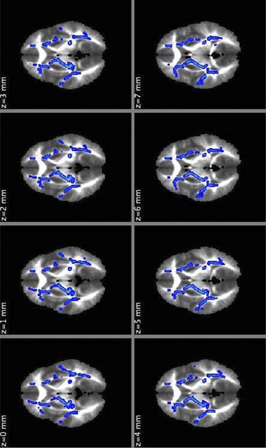 Figure 3. Regions of significant positive correlation between HbA1c values and RD (shown in light blue) within the type 1 diabetes group, shown in serial images in the axial orientation. Group differences were “thickened” for visualization purposes (shown in dark blue). (A high-quality digital representation of this figure is available in the online issue.)
