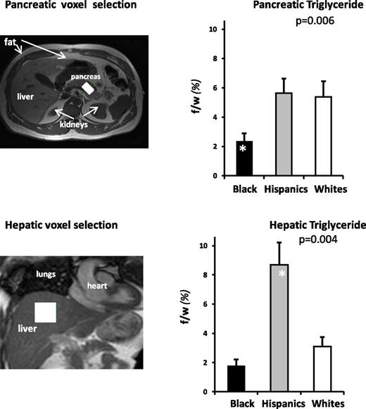 Figure 1. Pancreatic and hepatic steatosis. The axial abdominal magnetic resonance images (left) illustrate typical selection of the volume of interestvoxelin the pancreas and liver (white blocks on pancreas and liver images). The bar graphs illustrate pancreatic (top right) and hepatic (bottom right) TG content, expressed as fat-to-water ratio (f/w %), across race/ethnic groups. Pancreatic TG was approximately threefold higher in Hispanic and white than in black subjects (P = 0.006). In contrast, hepatic TG levels were approximately fivefold higher in Hispanic than in black subjects and approximately threefold higher than in white subjects (P = 0.004). (A high-quality color representation of this figure is available in the online issue.)