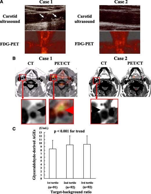 Figure 1. Representative coronal images of ultrasound and FDG-PET (A) and transaxial images of contrast-enhanced computed tomography (CT) and coregistration of FDG-PET and computed tomography (PET/CT) (B) in the carotid arteries of two case subjects. Age- and sex-adjusted AGE values stratified by carotid TBR tertiles (C). One is a case subject with high serum AGE levels (case 1) and the other with low serum AGE levels (case 2). A: White arrows show carotid atherosclerotic plaques, while red arrows indicate vascular FDG uptake. B: Black arrowhead denotes vessel wall or atherosclerotic plaque, while red arrowheads indicate vascular FDG uptake. C: When age- and sex-adjusted AGE values stratified by TBR tertiles were compared using ANCOVA, a significant trend was observed (P < 0.01). (A high-quality digital representation of this figure is available in the online issue.)