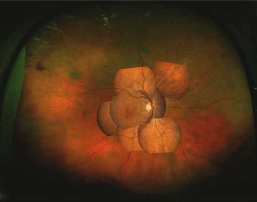 Figure 1. Overlay montage of a representative Optomap scan and ETDRS 7-field (mild NPDR). (A high-quality digital representation of this figure is available in the online issue.)