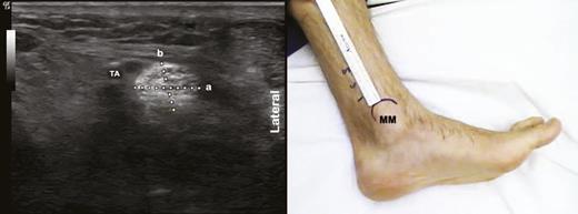 Figure 1. Right panel: ankle position, and US probe placement at 1, 3, and 5 cm proximal to the cephalad border of the medial malleolus (MM). Left panel: short-axis image of the PTN above medial malleolus. CSA is measured by multiplying the short (a) and long (b) axes of the PTN at each level (CSA = a × b × pi × 1/4). TA, posterior tibial artery. (A high-quality color representation of this figure is available in the online issue.)