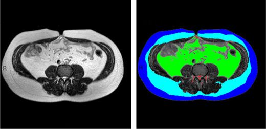Figure 1. MRI imaging of abdominal fat tissues compartments. The subcutaneous fascial plane was delineated using the computer interface semiautomatic method, where initially an intensity-based automatic segmentation was generated and presented followed by semimanual fine tuning. The area of each compartment was quantitated separately. Fat tissues of specific anatomical landmarks were quantified and divided into color-coded groups as follows: dark blue, superficial subcutaneous fat; light blue, deep subcutaneous fat; green, visceral adipose tissue; and red, nonclassified fat—fat surrounding the vertebrae and fat depots that were unrelated to each of the groups listed above. (A high-quality digital representation of this figure is available in the online issue.)