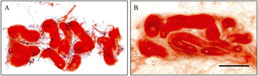 Figure 1. Sweat gland innervation in control and diabetic subjects. A: In the skin of control subjects, distinct sweat glands (red) and characteristic periglandular innervation (dark blue) are noticeable. Sudomotor nerve fibers exhibit linear and dense immunoreactivities and form a reticulated pattern. B: In skin of diabetic subjects, only sparse and fragmented immunoreactive profiles (dark blue) surround sweat glands (red), reflecting nerve degeneration. Bar = 100 μm. (A high-quality digital representation of this figure is available in the online issue.)