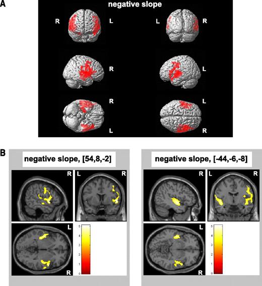 Figure 2. Insulin resistance is linked to deficits in temporal lobe gray matter volume in elderly men and women. VBM in 285 elderly men and women aged 75 years illustrates a significant inverse association between insulin resistance as indexed by the HOMA-IR and two major clusters situated in the left and right temporal lobe of the brain, as indicated by colored areas. A: Basic regression model rendering controlled for sex and TIV. B: Complex regression model further controlled for education, serum LDL concentration, mean arterial BP, and abdominal visceral fat volume as covariates of no interest. Neurologic sections were focused at the significant peak voxels (MNI coordinates shown in brackets), and the colored bar indicates the t values. All clusters illustrated were thresholded at P < 0.05 by using FWE. R, right brain hemisphere; L, left brain hemisphere. (A high-quality digital representation of this figure is available in the online issue.)