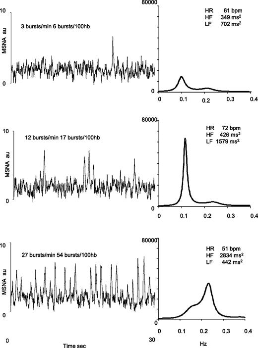 Figure 3. Raw MSNA signal (30-s recording for all) and corresponding spectral analysis of R-R interval (2 min recording for all) at baseline (upper panel), during the handgrip (middle panel), and during the cold pressor tests (lower panel). au, arbitrary units.