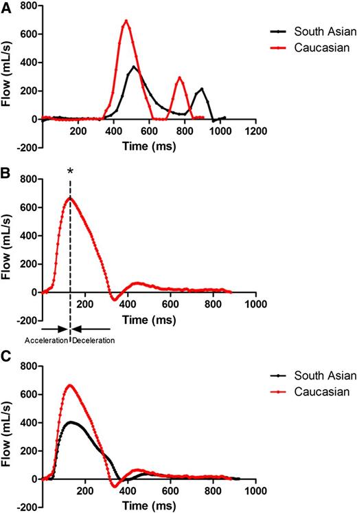 Figure 1. Mitral valve and aortic flow curves. A: Example of the flow through the mitral valve, representing diastolic cardiac function. The black line represents a South Asian subject, the red line a Caucasian subject. E and A peak filling rate (P < 0.001), E and A acceleration peak (P = 0.004 and P = 0.021, respectively), and E deceleration peak (P = 0.005) were lower in South Asians, suggesting a prolonged cardiac relaxation compared with Caucasians. B: How aortic flow parameters are assessed. The * is the aortic peak flow rate. Acceleration duration is the time between the beginning of the flow curve and the peak flow rate. The deceleration duration is the time between the peak flow rate and the end of the deceleration period. The acceleration peak is the peak slope (dy/dx) of the acceleration phase, and the deceleration peak is the peak slope (dy/dx) of the deceleration phase. C: Example of flow velocity curve through the ascending aorta. The black line represents a typical curve of a South Asian subject, the red line of a Caucasian subject. South Asians had lower acceleration (P = 0.004) and deceleration (P < 0.001) peak flows over the aorta, suggesting somewhat prolonged cardiac contraction compared with Caucasians.
