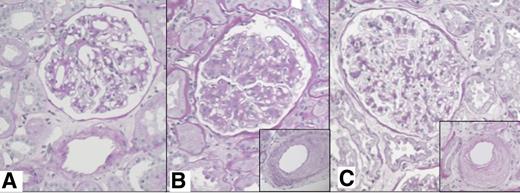 Figure 2. Histological appearances representative of normoalbuminuric cases. A: Patient 1, from Table 3, demonstrating normal glomerulus and arteries, Fioretto C1. B: Patient 3, from Table 3, demonstrating advanced diabetic GS and arteriosclerosis (inset), Fioretto C2. C: Patient 8, from Table 3, demonstrating minimal glomerular mesangial expansion and severe arteriosclerosis (inset), Fioretto C3 (all images periodic acid–Schiff stain, original magnification ×200).