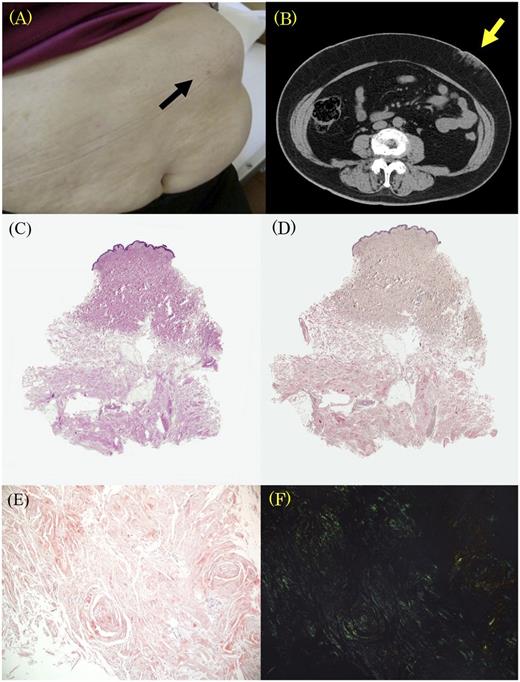 Figure 1. (A) A subcutaneous mass in a 69-year-old patient with type 2 diabetes. (B) Computed tomography of the subcutaneous mass. (C) Light microscopic findings of the abdominal mass showing widespread deposition of eosinophilic amorphous material in the subcutaneous tissue (loupe). Congo red staining highlighting the amyloid deposit (loupe). (D) Confirmation of an amyloid deposit by Congo red staining and (E) green birefringence via polarized microscopy [(F) magnification ×200)].