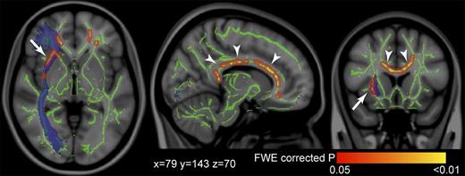 Figure 1. Results of a tract-based spatial statistics analysis for FA. Areas with significantly reduced FA values in subjects with metabolic syndrome compared with control subjects are shown by colors ranging from red to yellow (P < 0.05, the family-wise error [FWE] correction for multiple comparisons). We found significant reductions in FA values in part of the right external capsule (arrows) and in the entire corpus callosum (arrowheads). Results are superimposed on the MNI152 1-mm template supplied with FSL. The mean FA skeleton is shown in green. The right IFOF, which is derived from the JHU white matter tractography atlas supplied with FSL, is shown for reference in blue. Montreal Neurologic Institute space coordinates are provided in millimeters. (A high-quality digital representation of this figure is available in the online issue.)