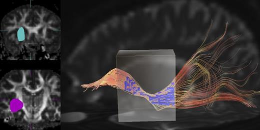 Figure 2. Tractography of the right IFOF. The seed regions-of-interest (blue area) were set in the anterior parts of the right external capsule (upper left panel). The target regions-of-interest (purple area) were set in the posterior parts of the right external capsule (lower left panel). In all subjects, tractographies of the right IFOF were obtained as gently curved tracts passing backward from the right frontal lobe, along the lateral border of the right caudate nucleus, and into the occipital lobe (right panel). (A high-quality digital representation of this figure is available in the online issue.)