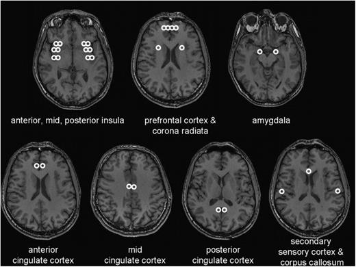 Anatomical magnetic resonance images illustrating the analyzed areas involved in the visceral sensory processing and in corpus callosum