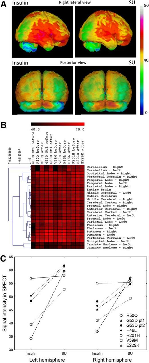 Figure 1. A: Representative SPECT scans of brain perfusion paired during insulin and SU therapy for the patient with a V59M substitution in Kir6.2 (NeuroGam software). B: Hierarchical clustering heat map for average signal intensity in the indicated brain regions for patients with the specified mutations before and after transfer to SU therapy. Brighter red represents increased 99mTc-ethyl cysteine dimer uptake corresponding to augmented perfusion. Pearson correlation coefficients were used as distance measurements in this analysis and are shown as a dendrogram on the left side of the heat map. C: Mean SPECT signal intensity in the left and right hemispheres of the cerebellum before and after initiation of SU treatment.