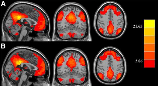 Figure 1. Significant brain functional connectivity to the PCC using one-sample t test in (A) healthy controls and (B) type 2 diabetic patients. Thresholds were set at a corrected P < 0.05, determined by Monte Carlo simulation. Note that the left side corresponds to the right hemisphere.